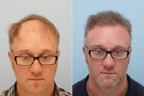 HE-clinic-before-and-after-hair-transplant.