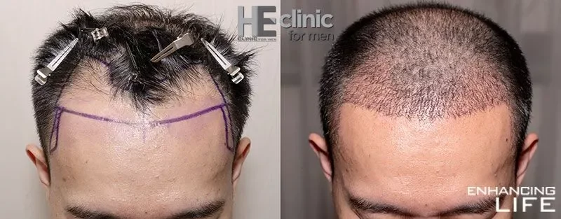 he-clinic-FUE-hair-loss-treatment